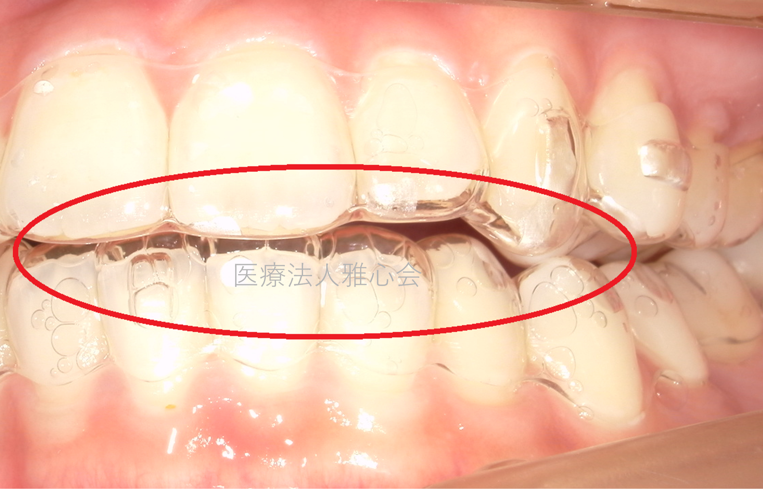 マウスピースが浮いた？その原因と対処法とは | 医療法人雅心会 中村歯科