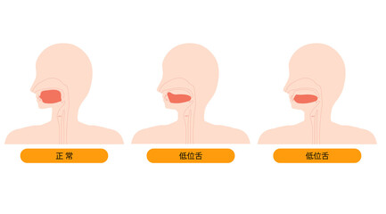 低位舌と正しい舌の位置