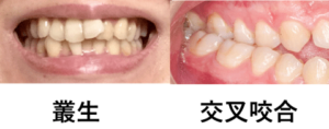 叢生交叉咬合