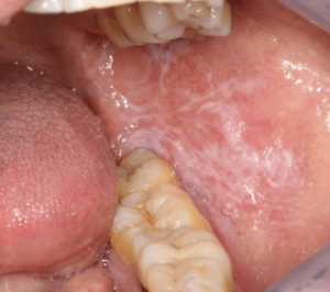 口腔扁平苔癬イメージ